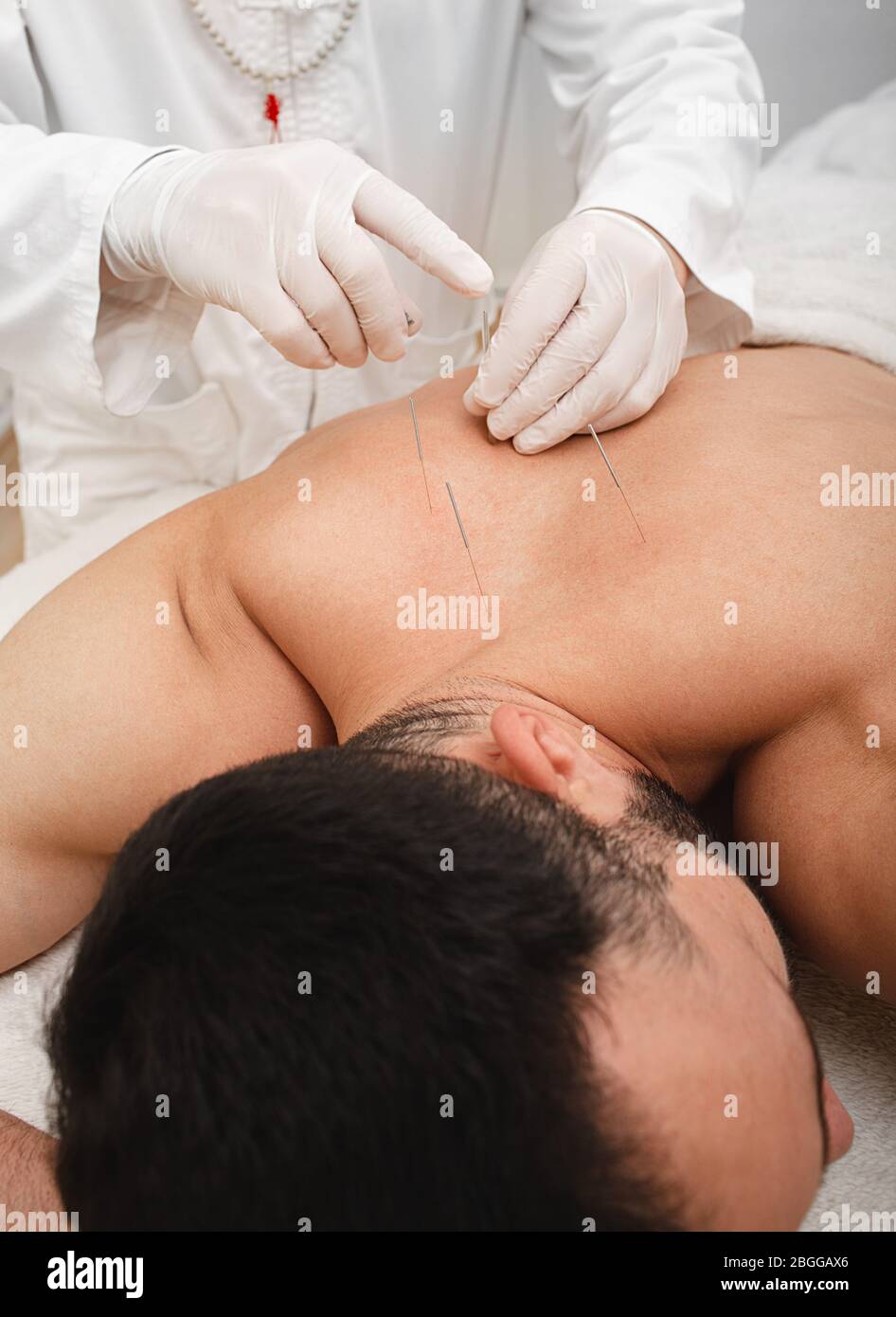 Akupunkturist punktiert Nadel an speziellen Punkten auf der Rückseite und ist sehr genau. Akupunktur aus nächster Nähe. Traditionelle chinesische Medizin Stockfoto