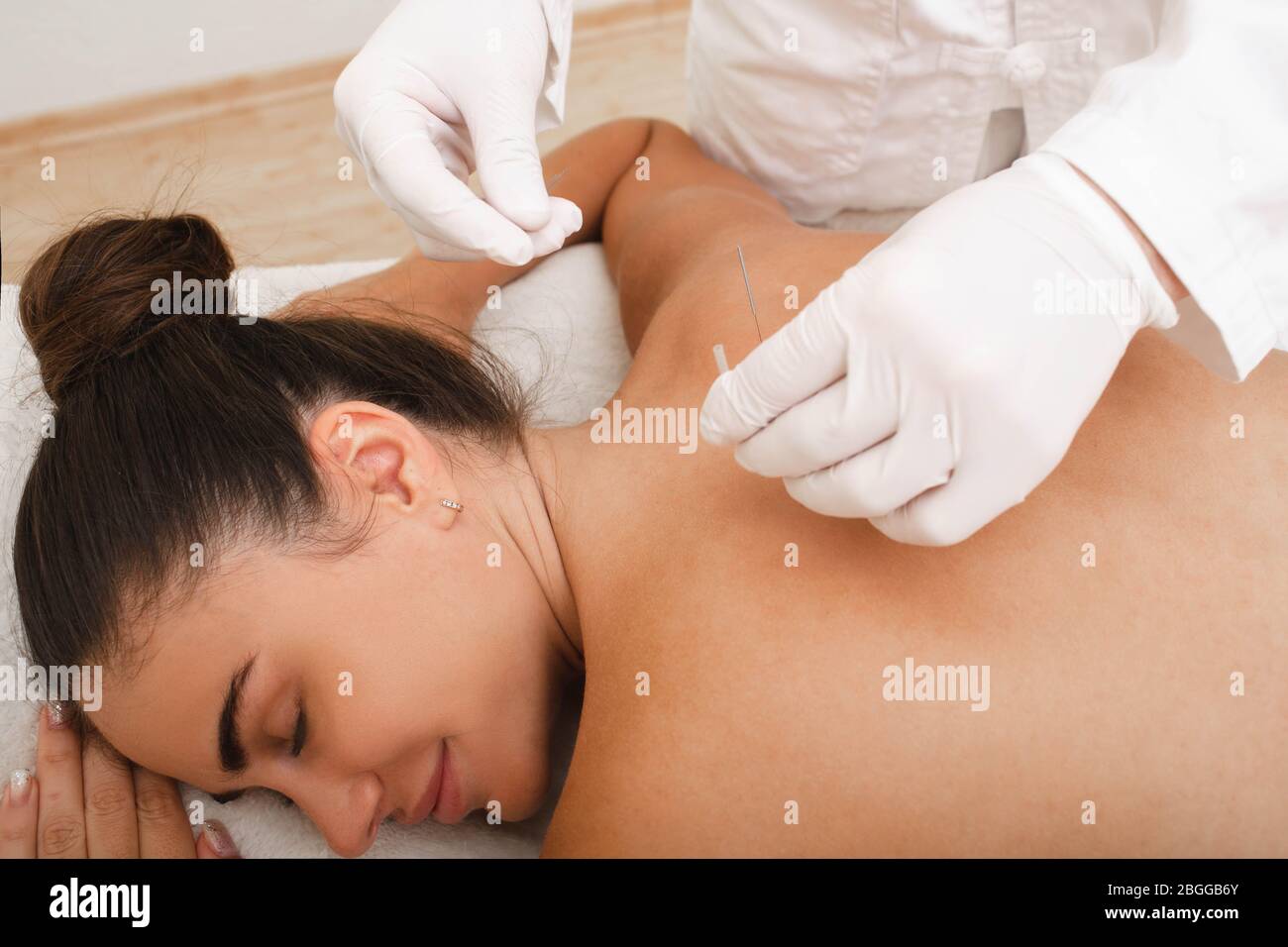 Frau auf Akupunktur Verfahren für die Behandlung von Rücken . Traditionelle chinesische Medizin Stockfoto