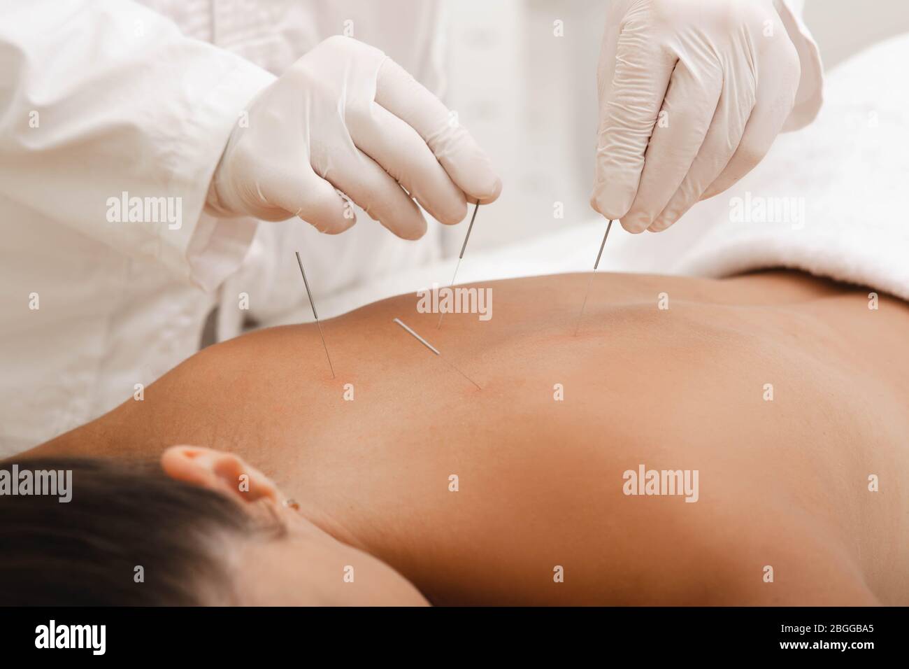 Akupunkturist punktiert Nadel an speziellen Punkten auf der Rückseite und ist sehr genau. Akupunktur aus nächster Nähe. Traditionelle chinesische Medizin Stockfoto