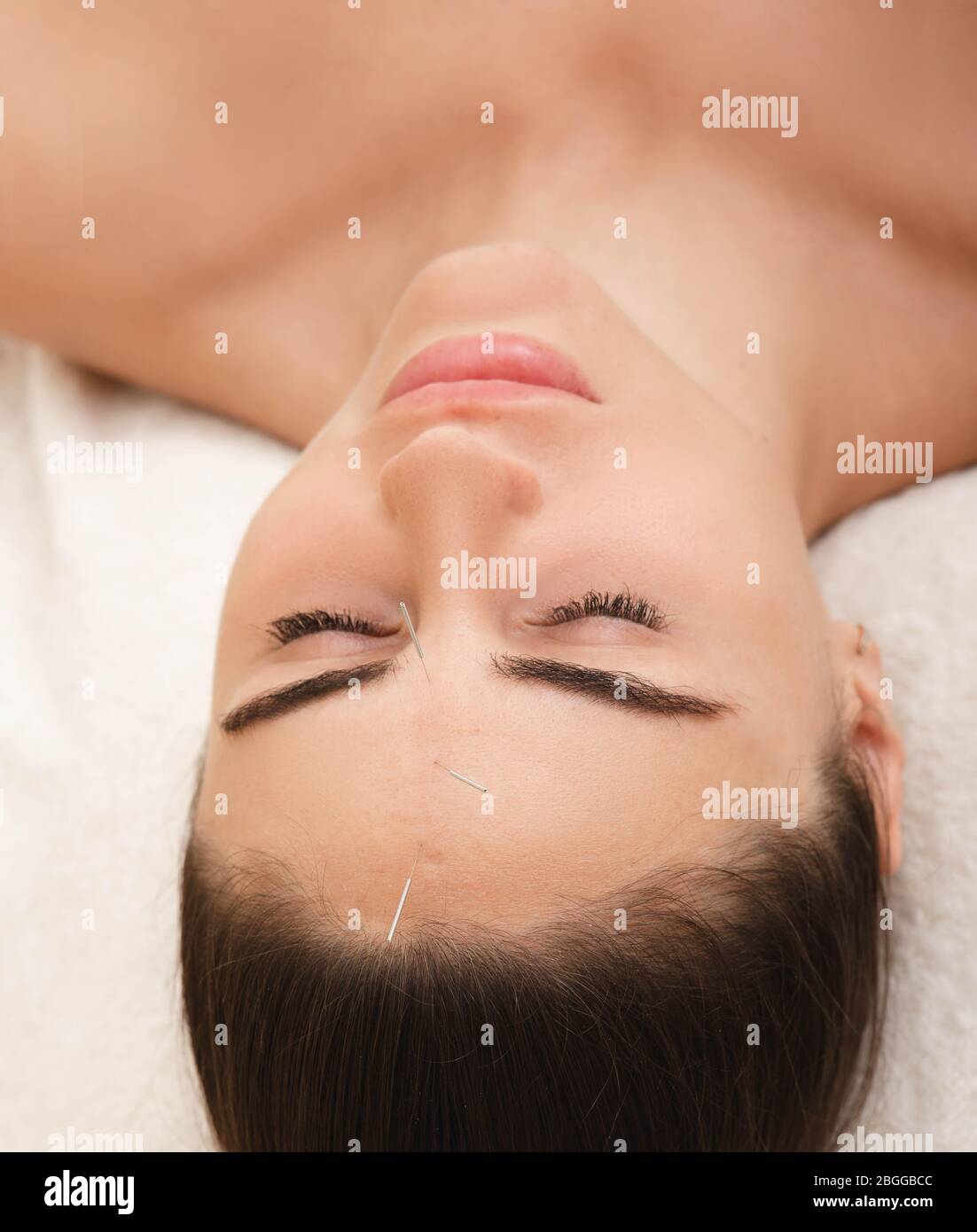 Antistress. Akupunktur des Kopfes einer Frau hilft, Migräne loszuwerden. Alternative Medizin Stockfoto