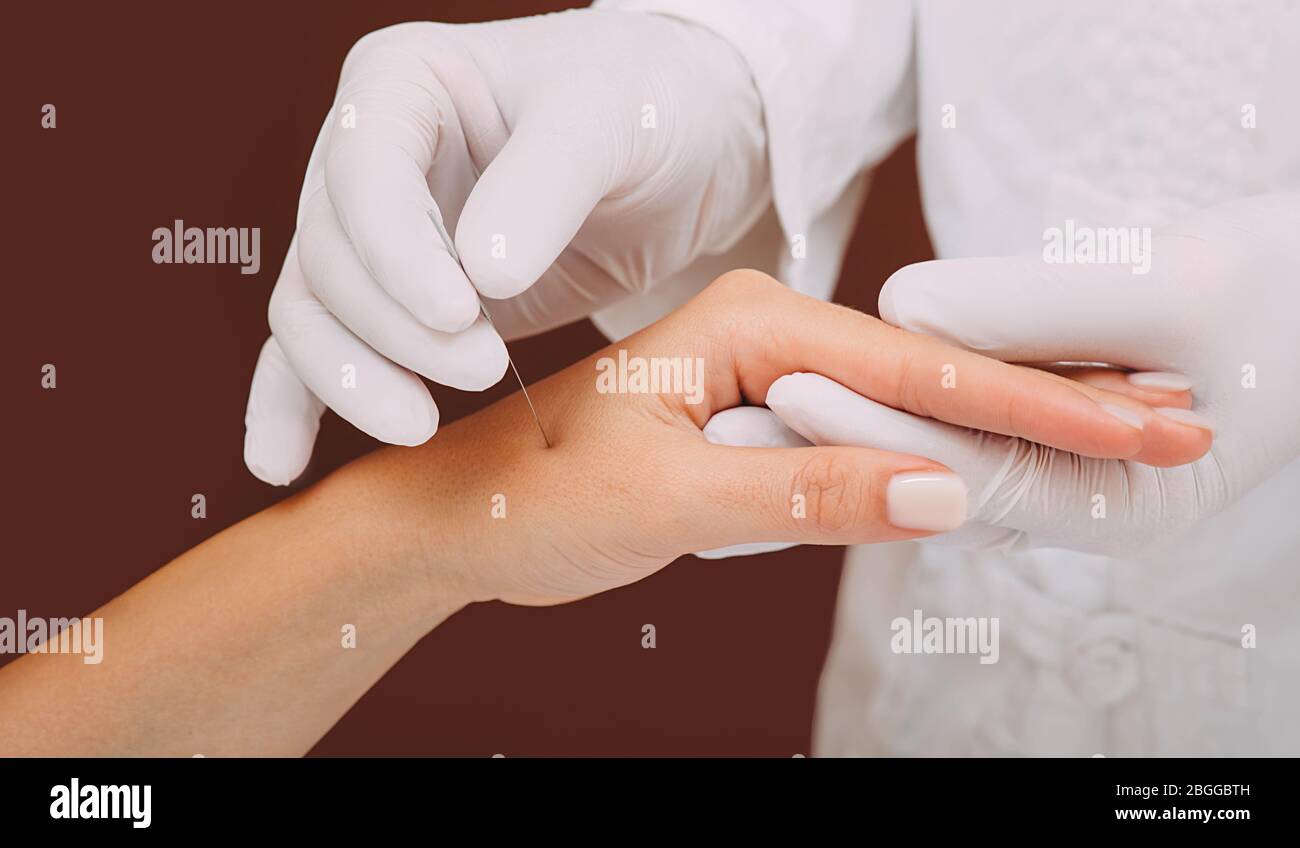 Frau Körperbehandlung Akupunktur Hand. Alternative orientalische Medizin Stockfoto