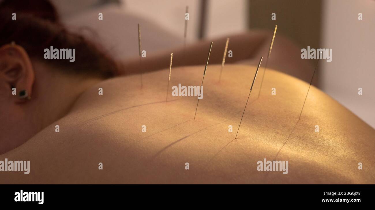Acupuncturist Einführen einer Nadel in eine weibliche zurück. Patienten mit der traditionellen Chinesischen Behandlung mit Nadeln einen Energiefluss durch spec Wiederherstellen Stockfoto