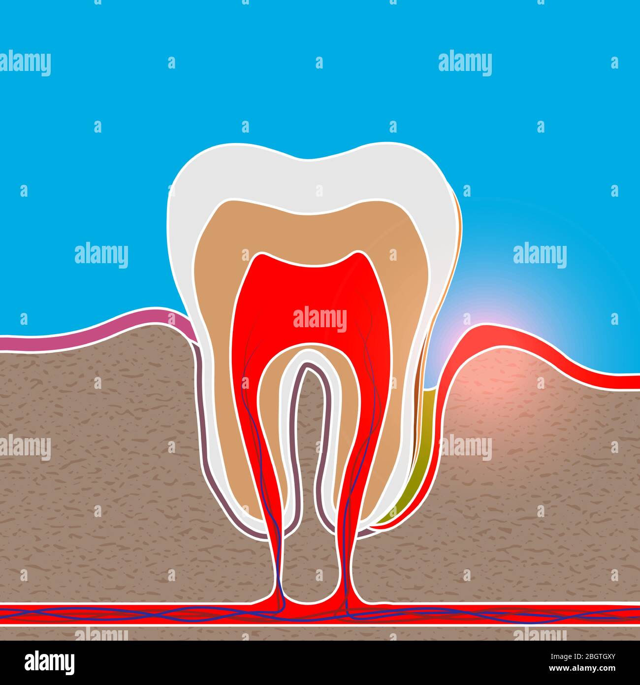 Wurzelentzündung, Gum-Krankheit, Eiter in der Zahnfleischtasche, Plaque und  Zahnstein. Parodontitis, Parodontitis, Gingivitis Stock-Vektorgrafik - Alamy