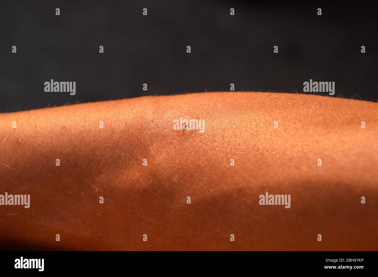 Bienenstich. Bienenstich in der menschlichen Haut. Die Folgen des Stichens  mit Bienengift Stockfotografie - Alamy