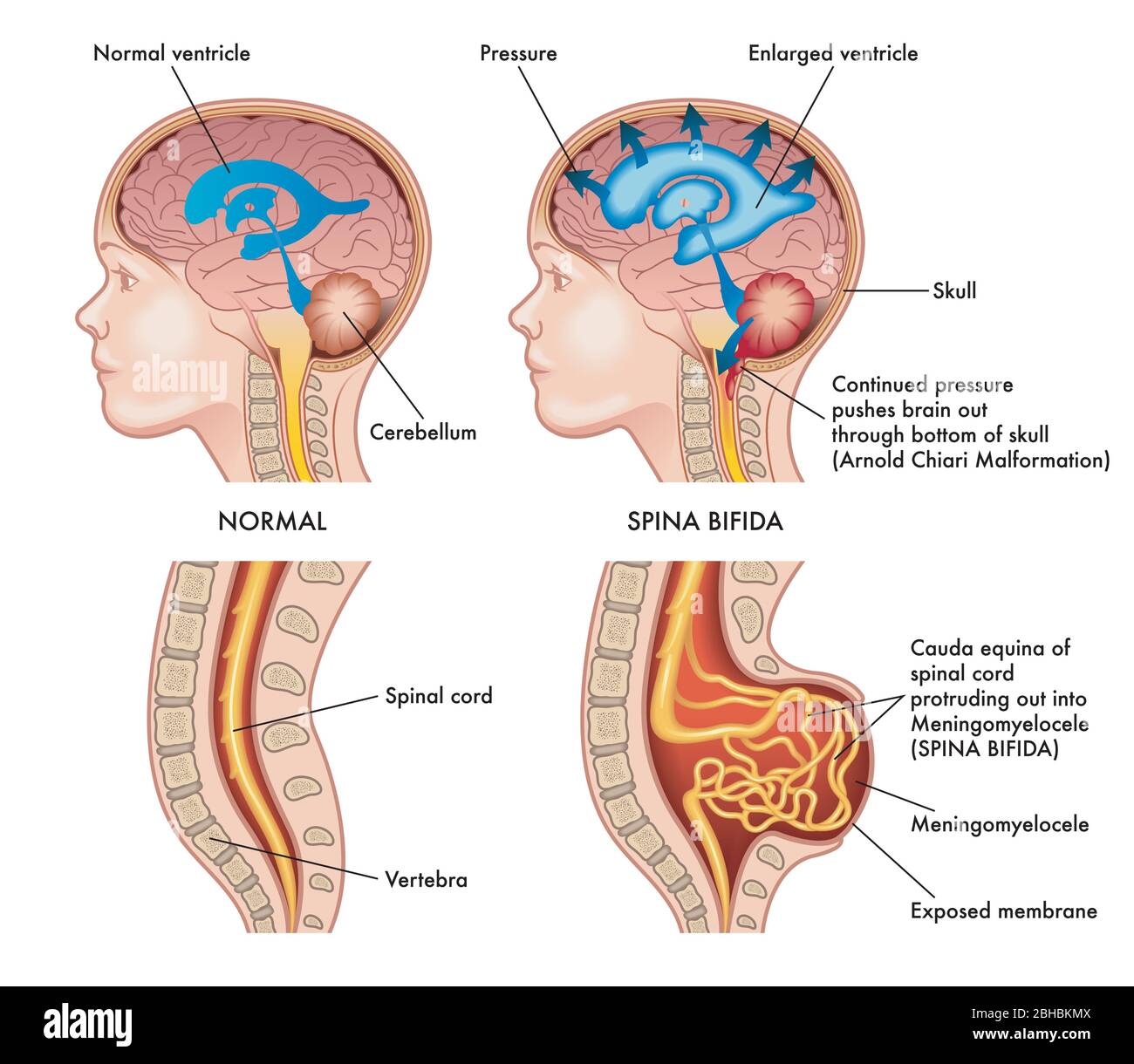 Medizinische Illustration zeigt ein Kind in zwei Situationen, links gesund und rechts von Spina bifida mit Anmerkungen, die die Symptome der befallen Stock Vektor