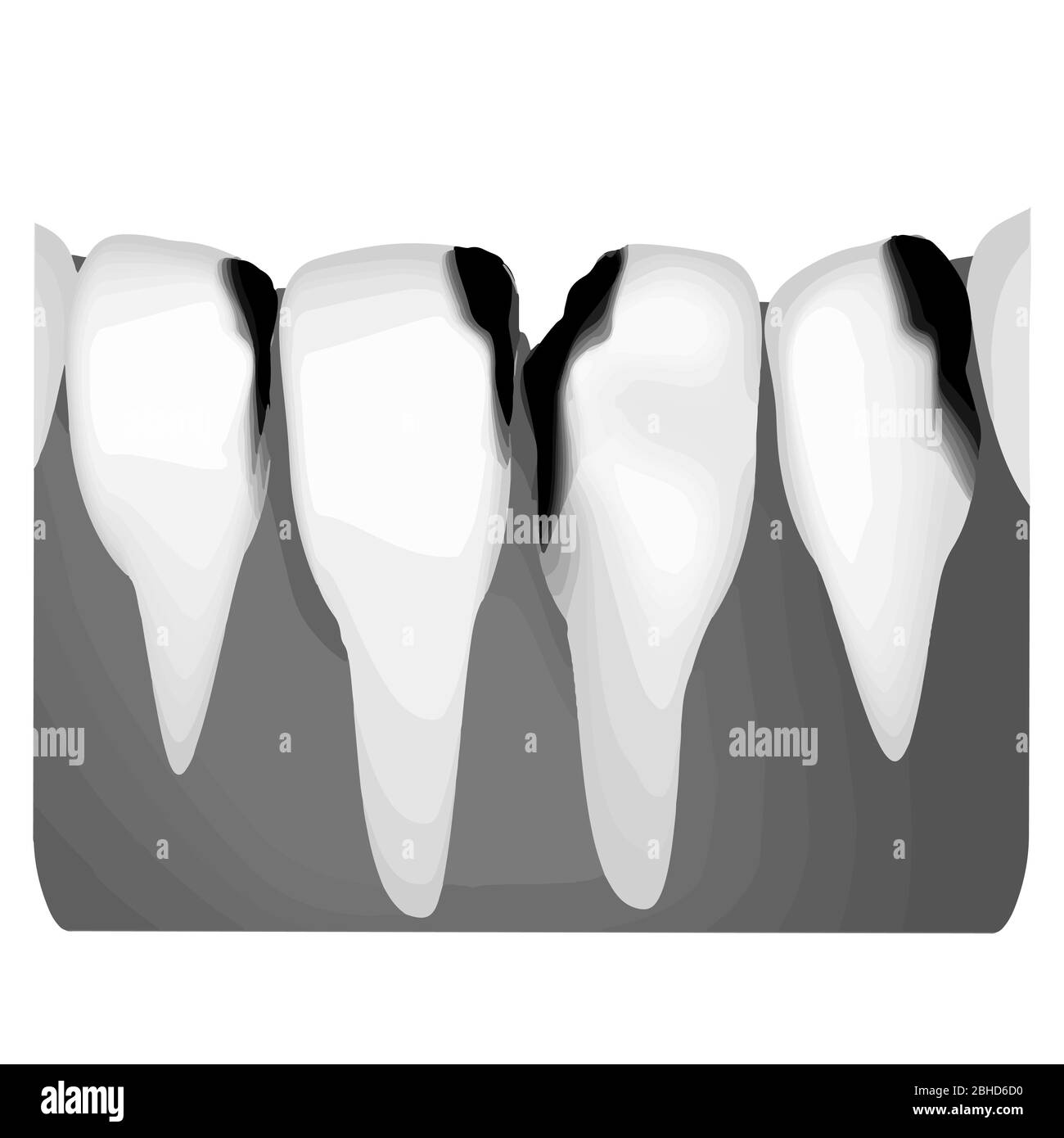 Karies. Röntgenaufnahme von Karies. Karies-Infografiken. Vektorgrafik auf isoliertem Hintergrund. Stock Vektor