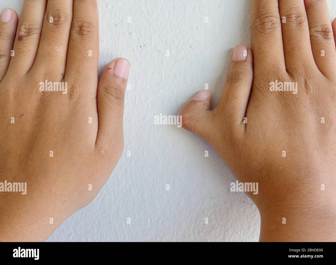 Foto von polydactyly auf dem Menschen; seltene abnorme charakteristische Ursachen durch Chromosom. Stockfoto