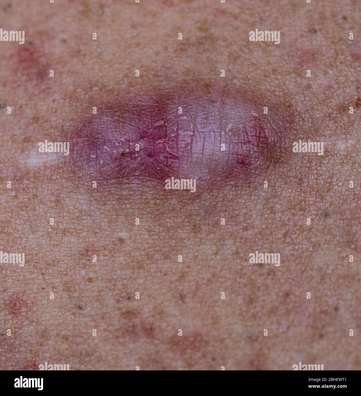 Chirurgische Narbe verwandelte sich in Keloid Stockfoto