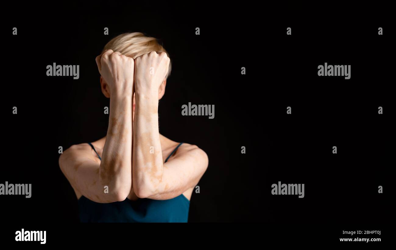 Frau mit Dermatologie Problem, deckt Gesicht, Panorama Stockfoto