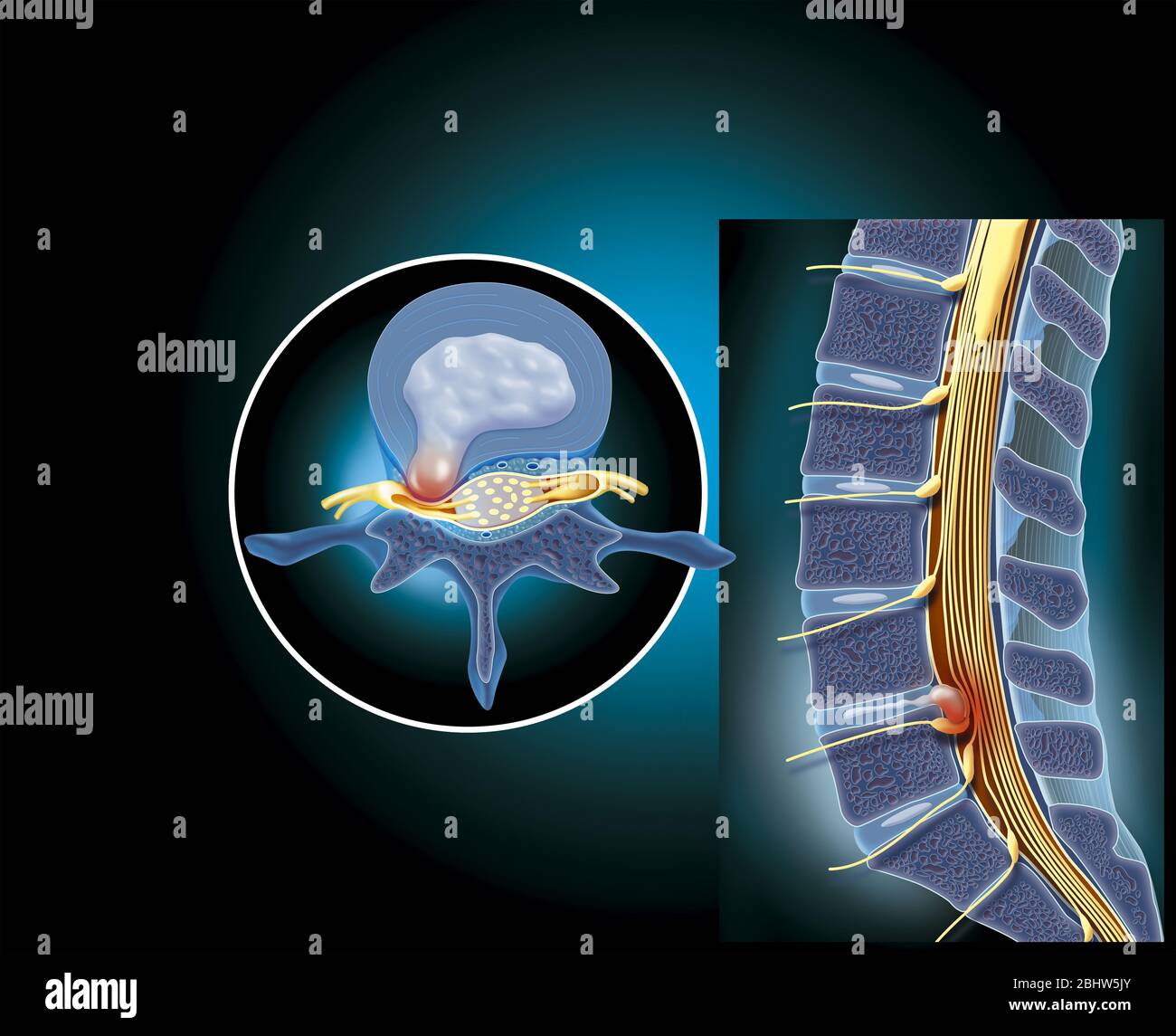Medizinische Illustration zeigt einen Bandscheibenvorfall auf Höhe von L4-L5, der die Nerven des Pferdeschwanzes zusammendrückt. Der Lendenwirbelscheibenvorfall (Forts Stockfoto