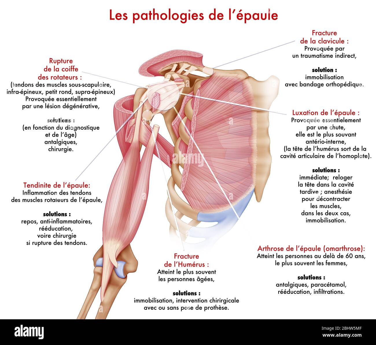Medizinische Illustration, die Pathologien der Schulter darstellt. Die Gelenkkapsel, die Bänder, die kleinen Pectoralis und die korakobrachischen Sehnen Stockfoto