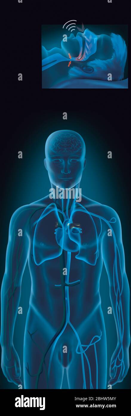 Medizinische Illustration, die Schlafapnoe und Organe darstellt, die von den Auswirkungen dieser Pathologie auf den Körper betroffen sind (obstruktive Apnoe). Weichteile am Th Stockfoto