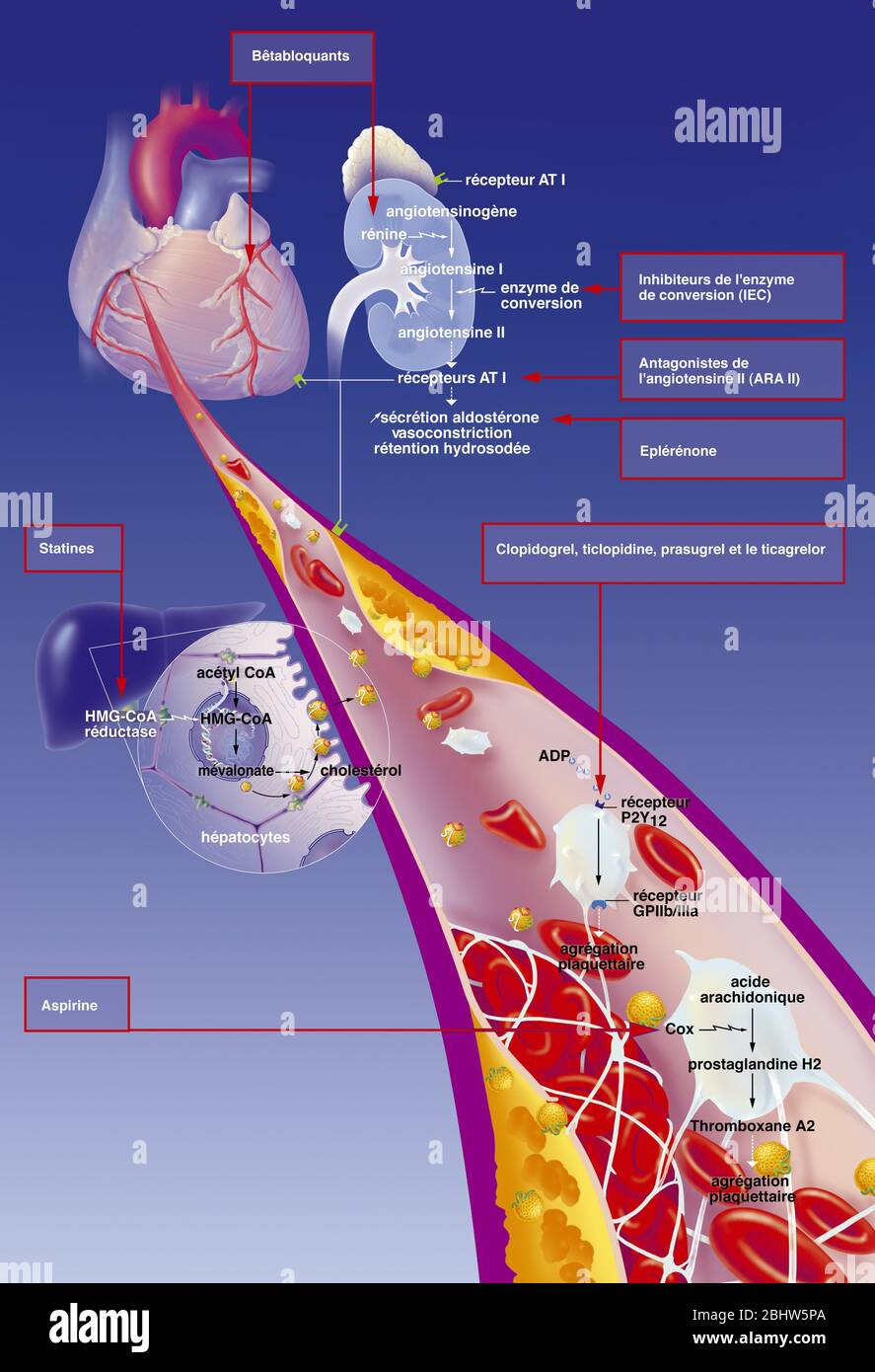 Myokardinfarkt, Koronararterie mit Thrombus, atheromatöse Plaques, Behandlungen. Die atheromatösen Plaques (gelb) in der Wand des Koronarkranzs Stockfoto