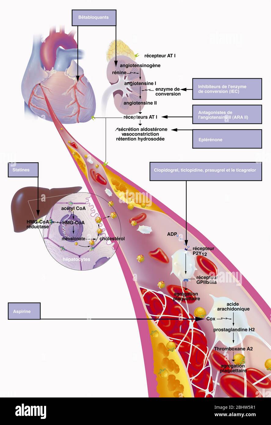 Myokardinfarkt, Koronararterie mit Thrombus, atheromatöse Plaques, Behandlungen. Die atheromatösen Plaques (gelb) in der Wand des Koronarkranzs Stockfoto