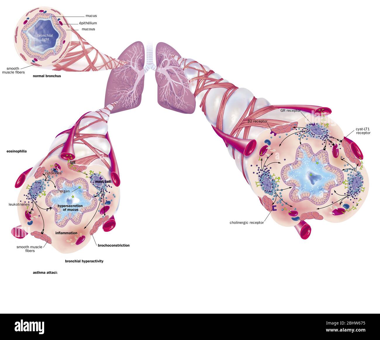 Asthma, normale Bronchiole, asthmatische Bronchiole mit Bronchokonstriktion, Hypersekretion, Behandlungen. Darstellung der Lunge mit der Bronchialzunge Stockfoto