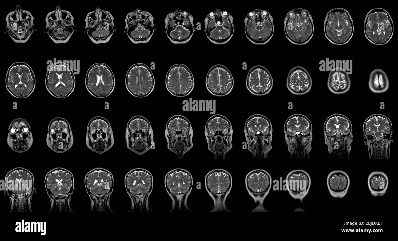 Set von seriellen MRT-Aufnahmen von sechzig Jahre alten Kaukasier Weiblicher Kopf in frontaler und horizontaler Ebene Stockfoto