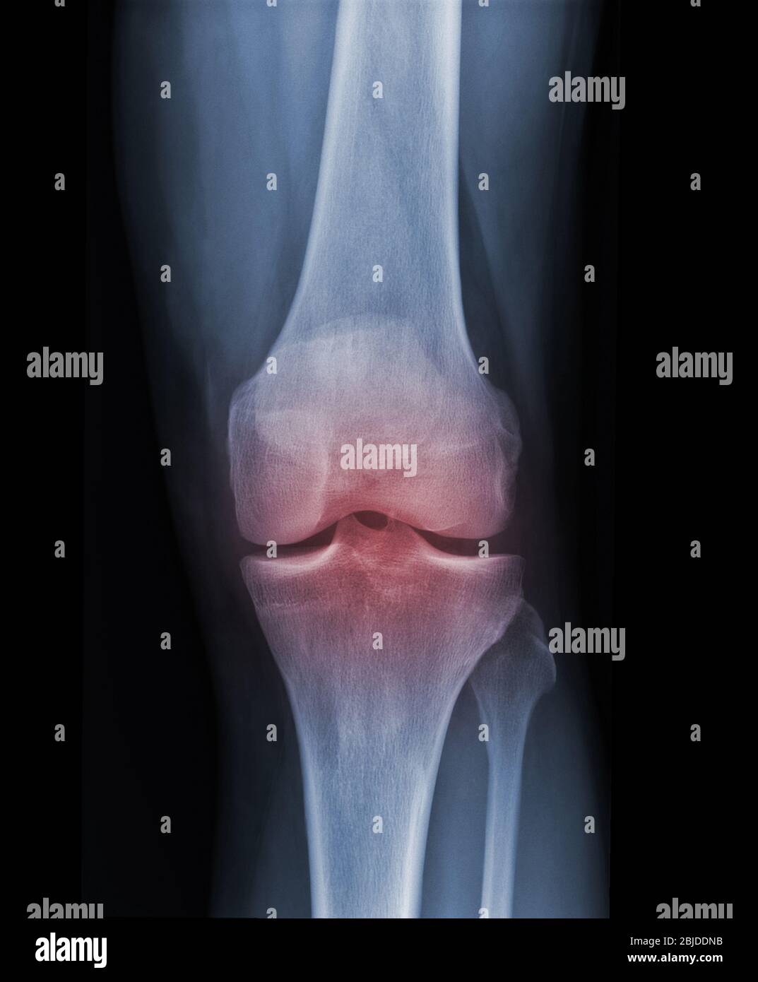 Röntgenaufnahmen des Kniegelenks zeigen den Verletzungszustand Stockfoto