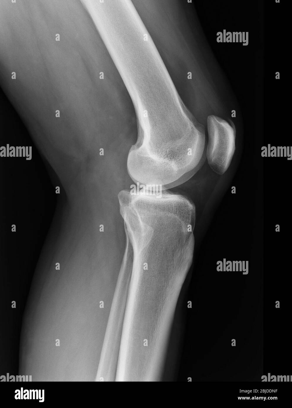 Röntgenaufnahmen des Kniegelenks zeigen den Verletzungszustand Stockfoto