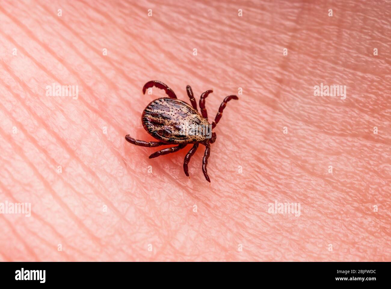 Enzephalitis infizierte Zecken Insekt kriechen auf der Haut. Enzephalitis Virus oder Lyme Borreliose Infektiöse Dermacentor Tick Arachnid Parasiten Makro Stockfoto