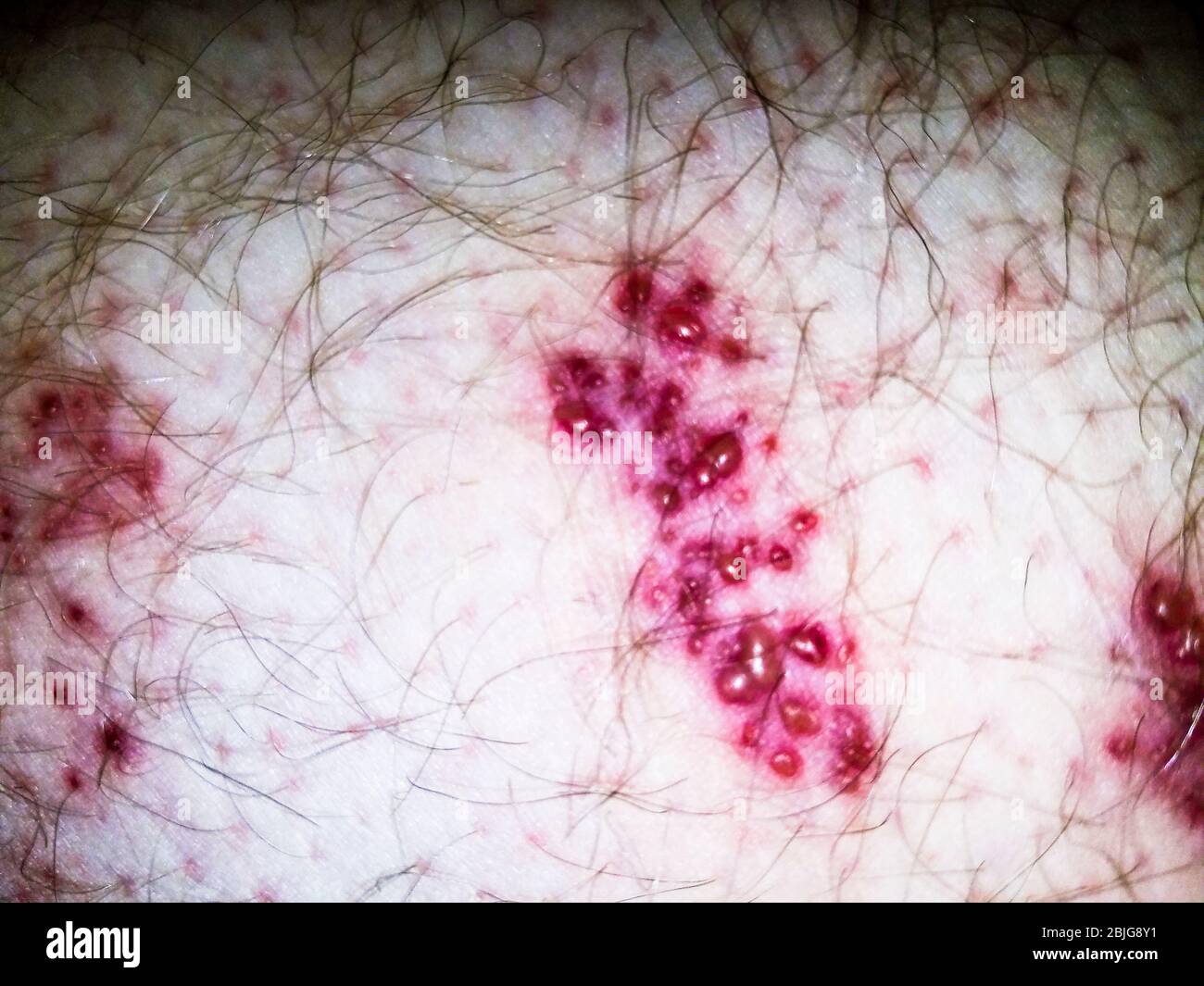 Herpes zoster virus illustration -Fotos und -Bildmaterial in hoher ...