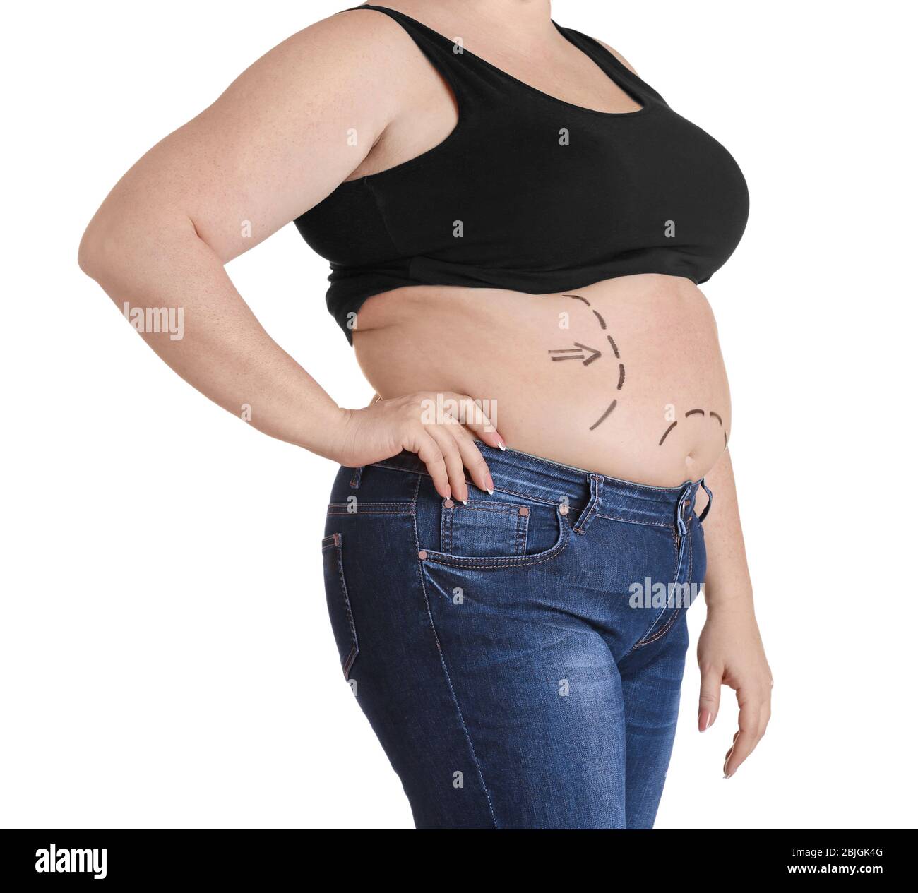 Stout Erwachsene Frau mit Markierungen auf dem Bauch für Kunststoff-Operation. Gewichtsverlust Konzept Stockfoto