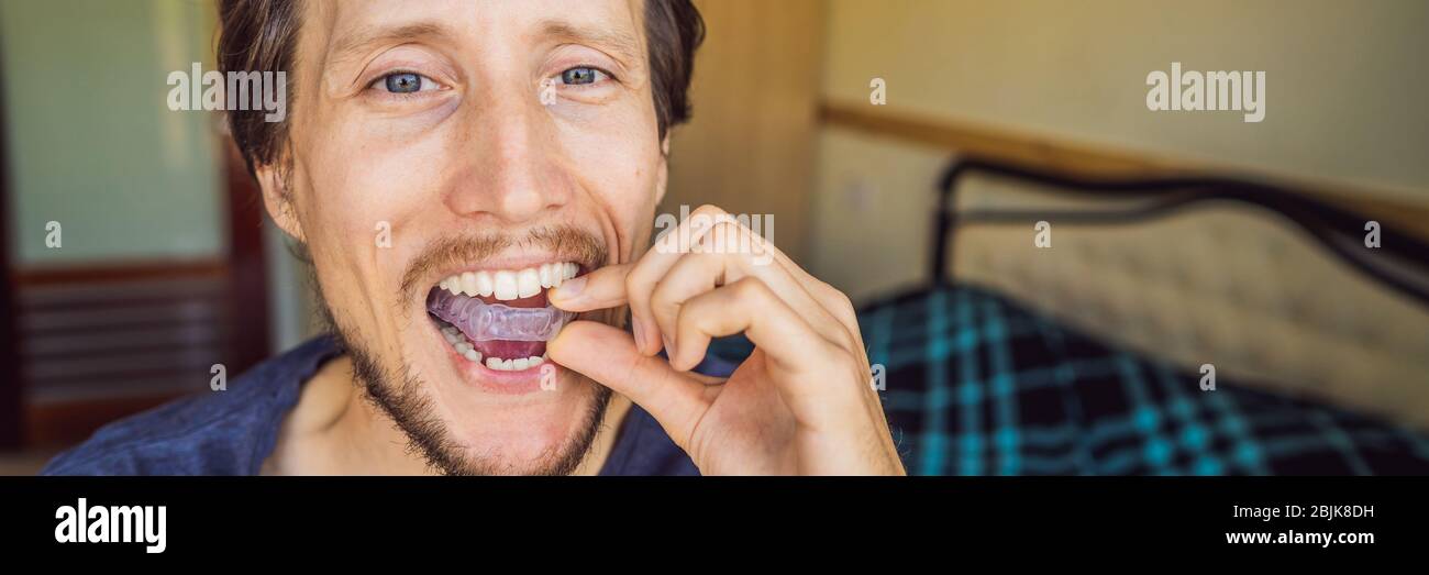 Mann Platzierung einer Aufbissplatte in seinen Mund, seine Zähne zu schützen in der Nacht vom Schleifen Nahaufnahme von Bruxismus, verursacht von seiner Hand und das Gerät Stockfoto
