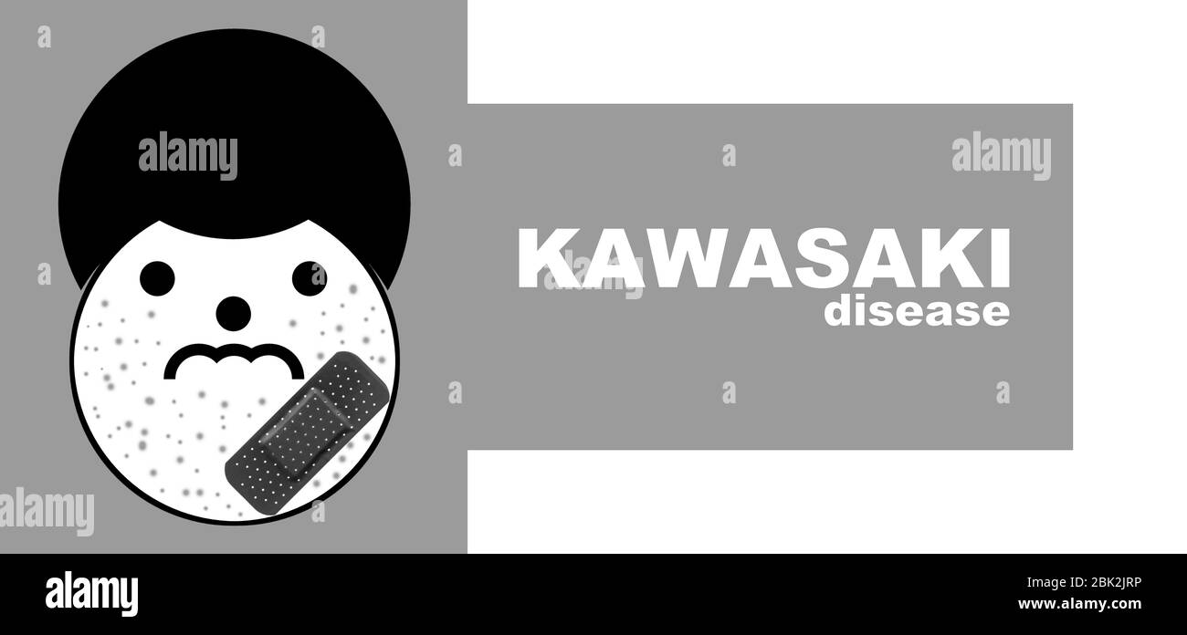 KAWASAKI-KRANKHEIT auch bekannt als Kawasaki-Syndrom (Mukokutane Lymphknoten-Syndrom), verursacht Entzündungen der Blutgefäße im ganzen Körper Stockfoto