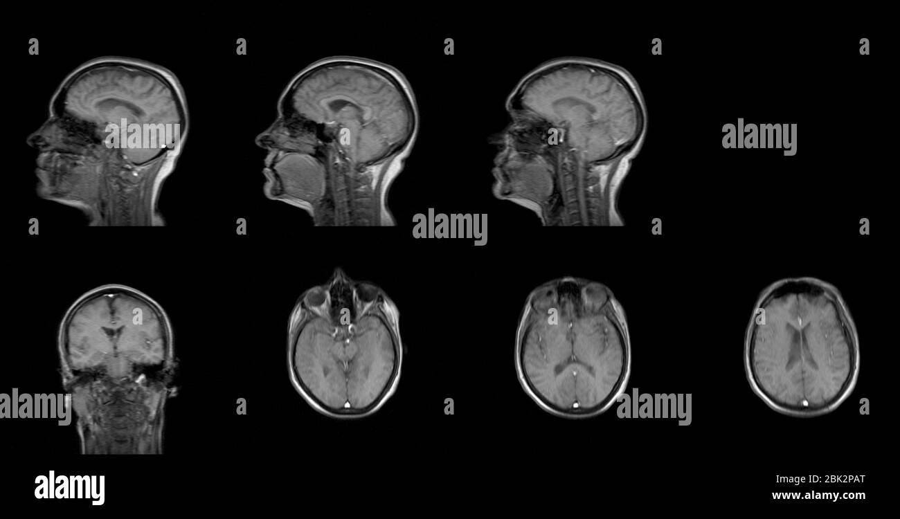 Set von seriellen MRT-Aufnahmen von sechzig Jahre alten Kaukasier Weiblicher Kopf in sagittalen und horizontalen Ebenen Stockfoto