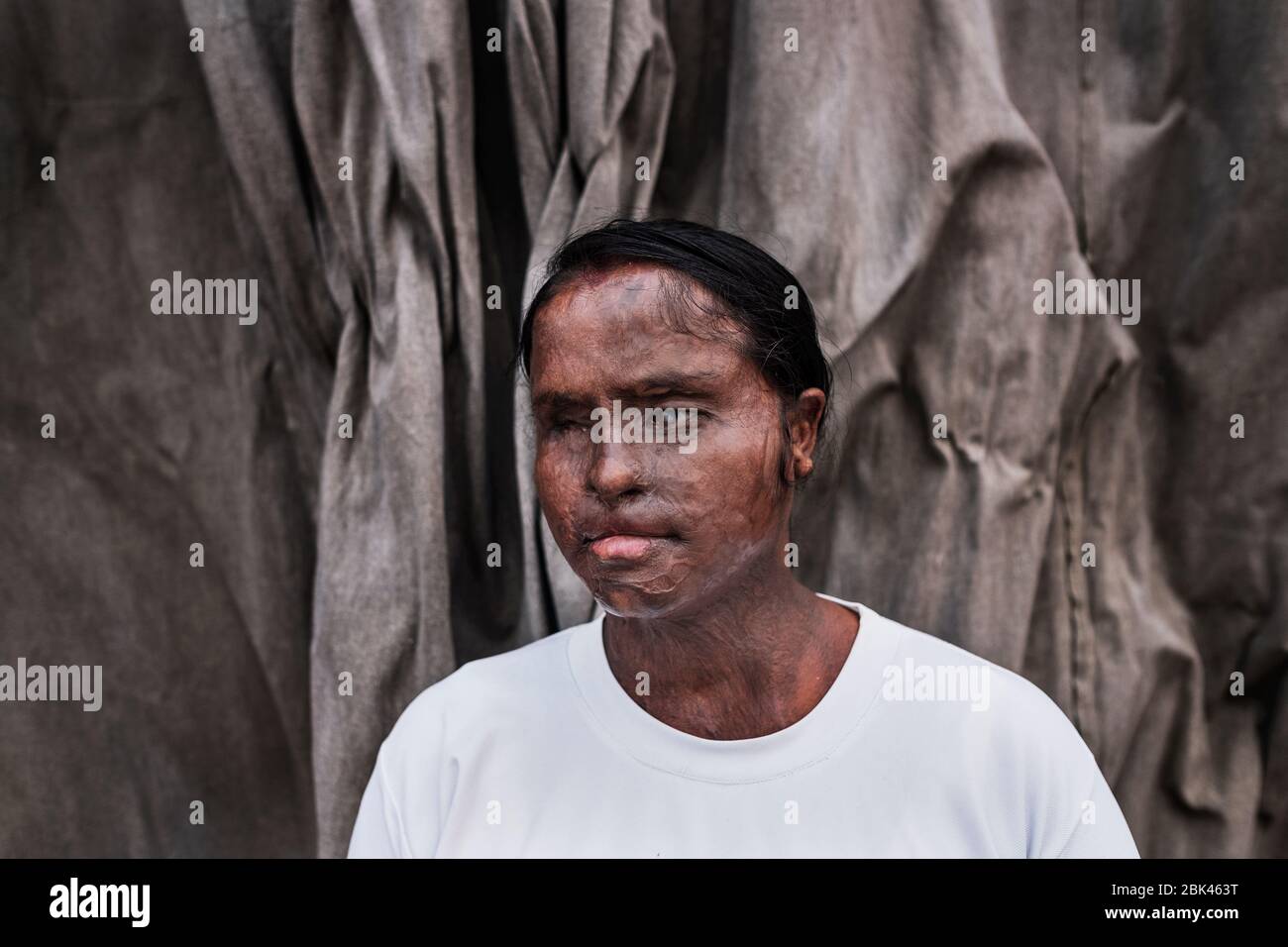 Überlebender des Acid-Angriffs, Indien Stockfoto