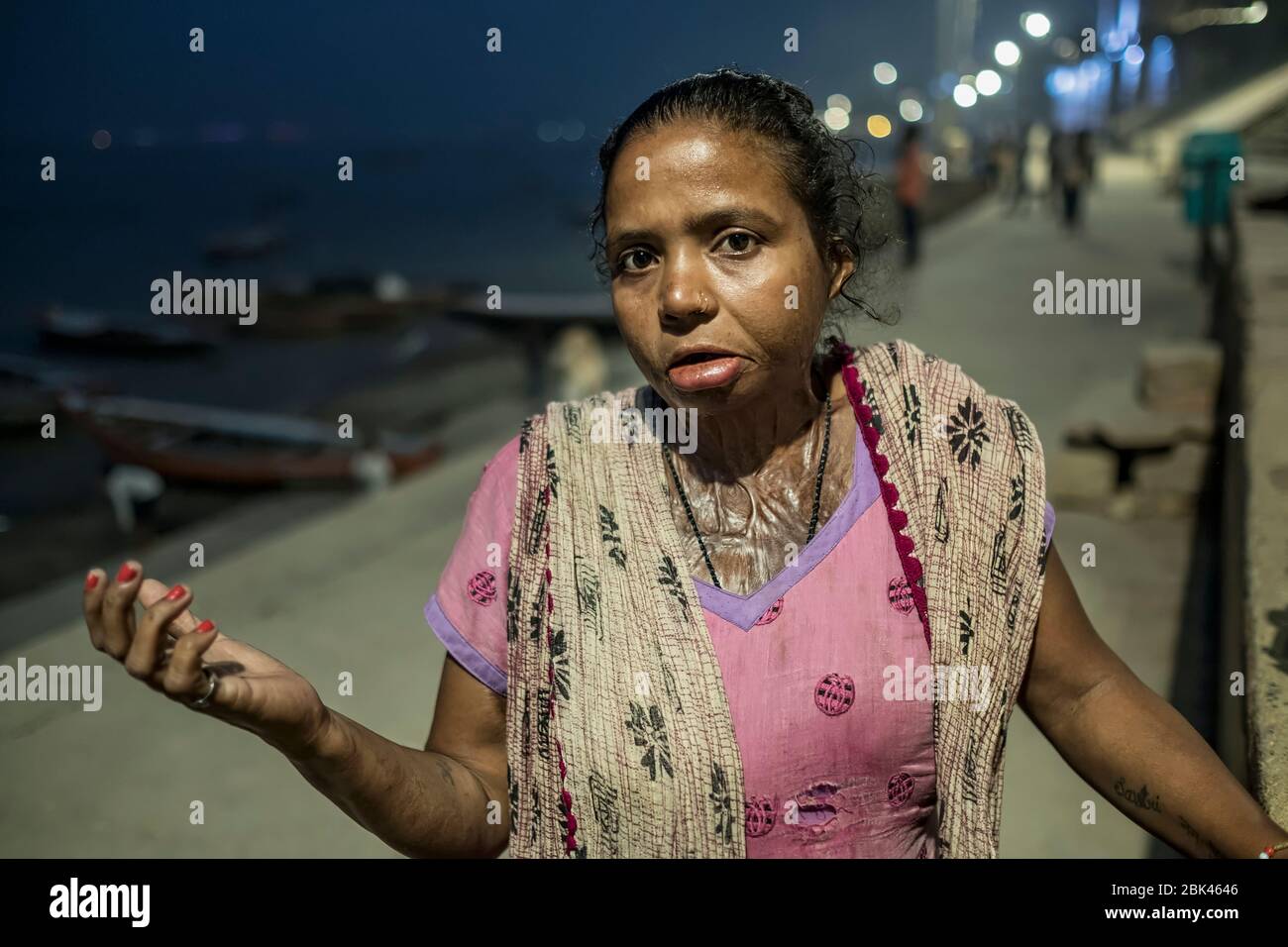 Überlebender des Acid-Angriffs, Indien Stockfoto