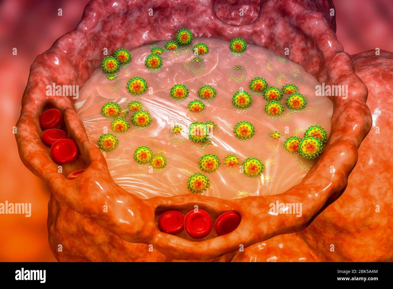 Menschliche Alveolen gefüllt mit Flüssigkeit und SARS-CoV-2-Viren während COVID-19-Infektion, konzeptionelle Computerdarstellung. Stockfoto