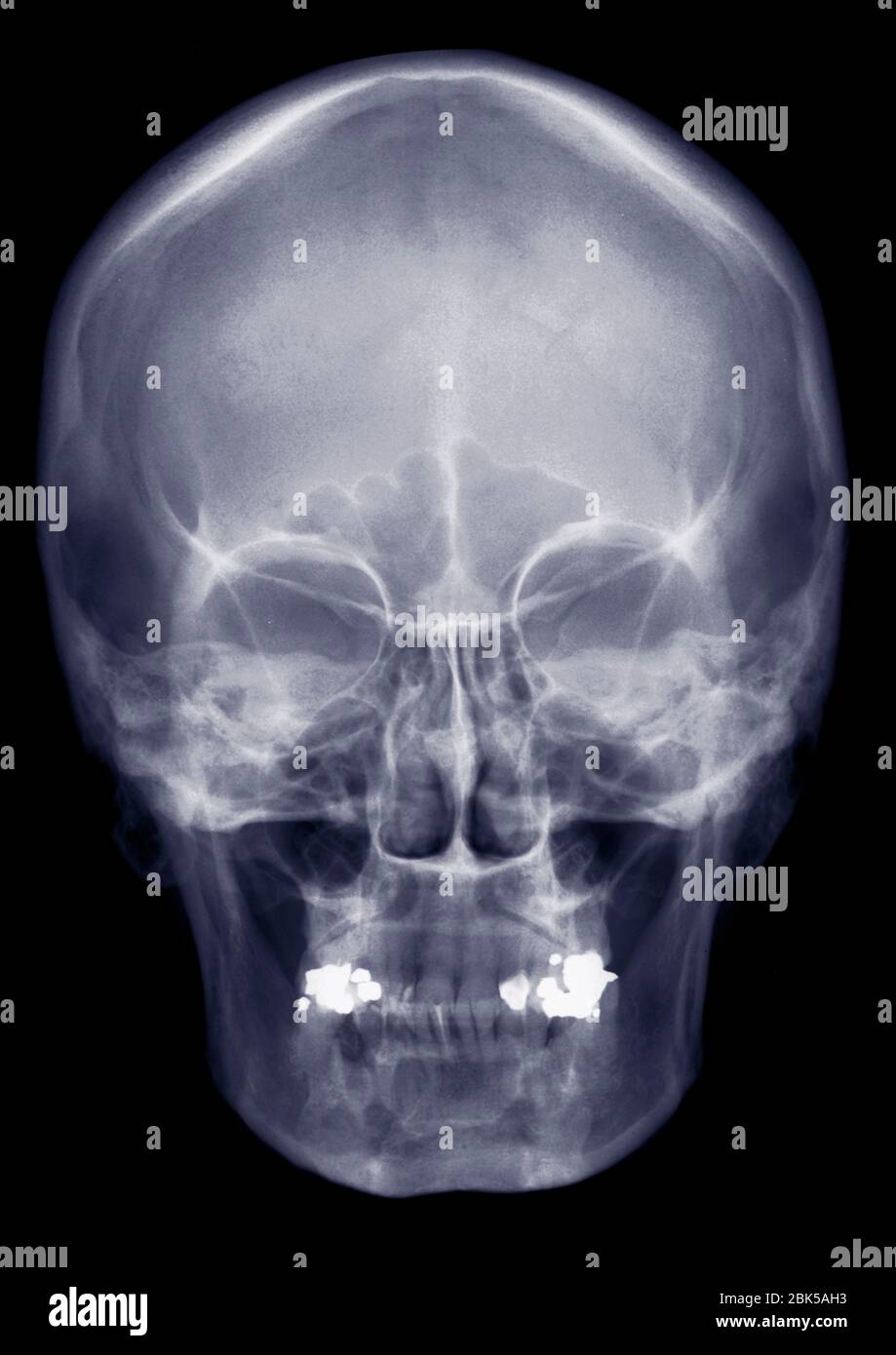 Menschlicher Schädel von vorne, Röntgen. Stockfoto