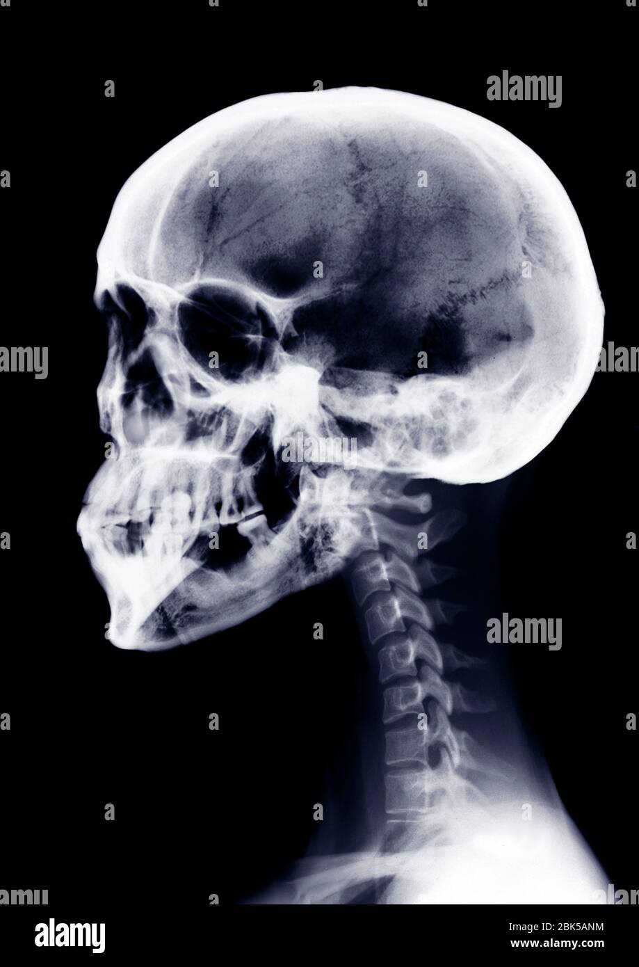 Menschlicher Schädel und Hals, Röntgenstrahlung. Stockfoto