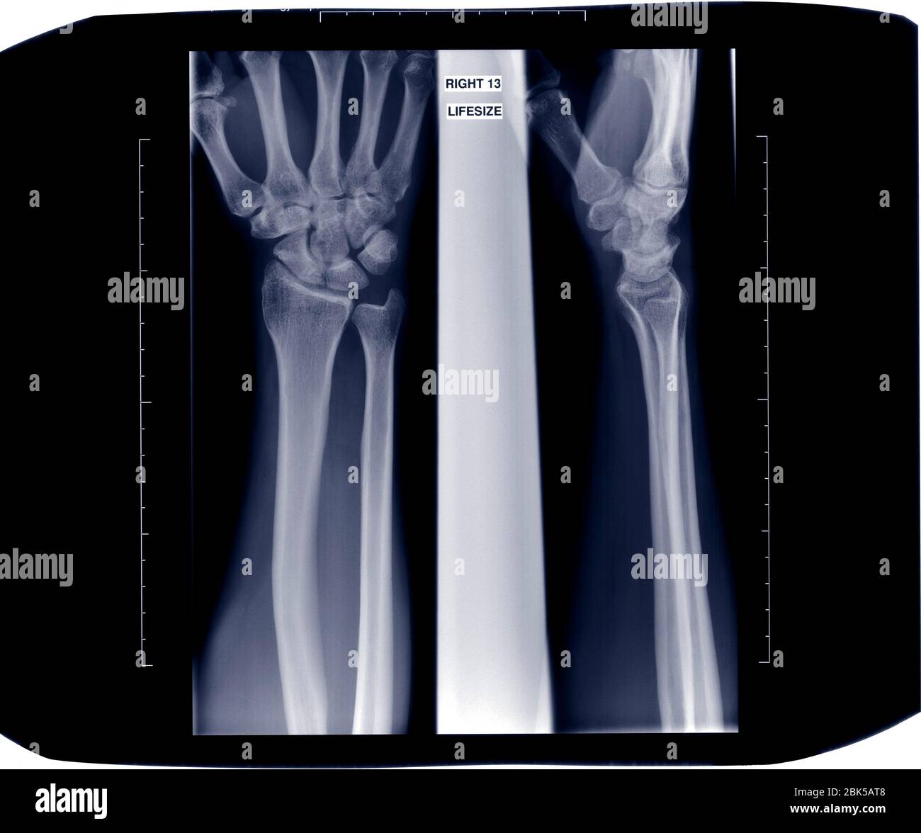Zwei Arme und Handgelenke, Röntgen. Stockfoto