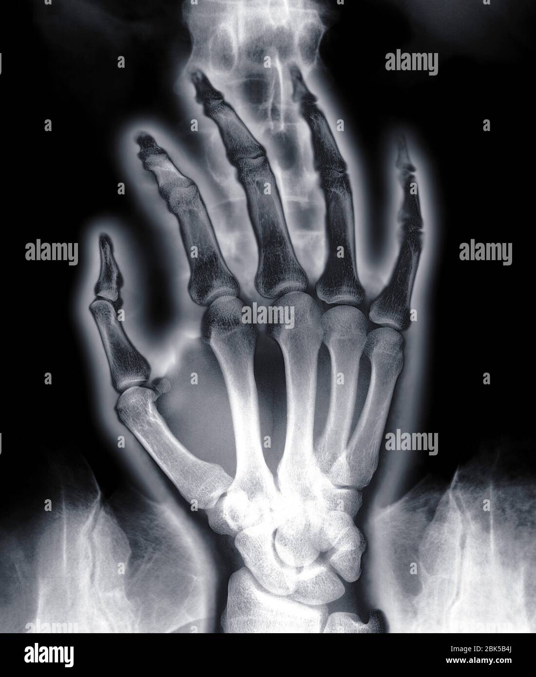 Menschliche Hand über Wirbelsäule, Röntgen. Stockfoto