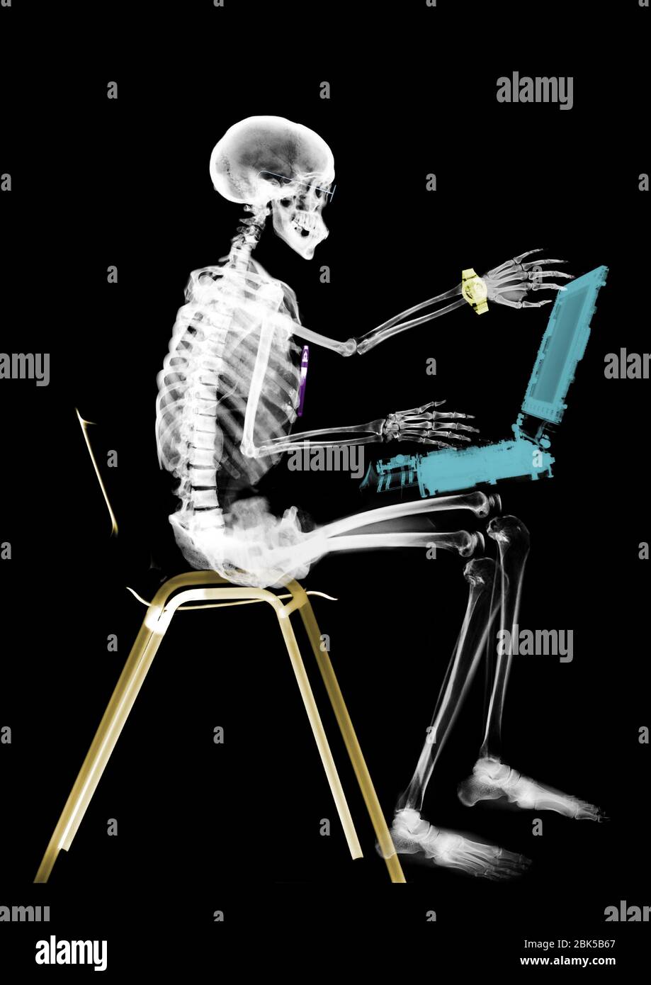 Menschliches Skelett sitzt mit Laptop-Computer, farbige Röntgenstrahlung. Stockfoto