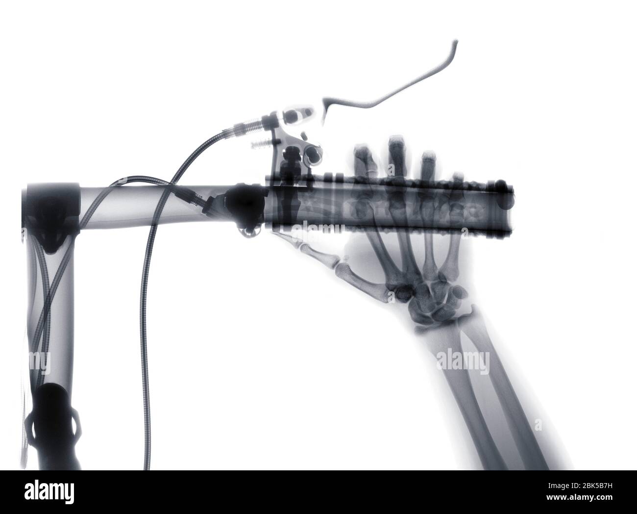 Menschliche Hand drücken Bremse auf Fahrrad, Röntgen. Stockfoto