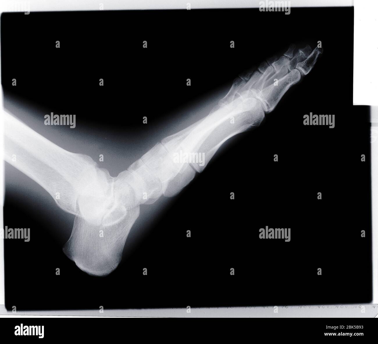 Menschlicher Fuß, Röntgenstrahlung. Stockfoto