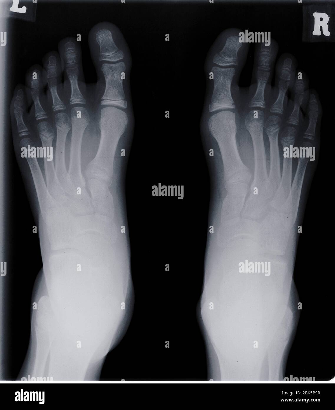 Menschliche Füße, Röntgenstrahlung. Stockfoto
