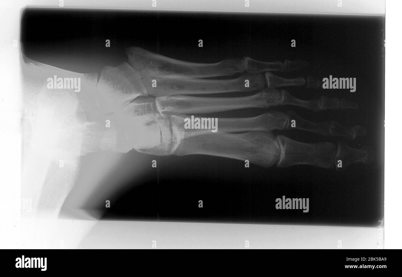 Menschlicher Fuß, Röntgenstrahlung. Stockfoto