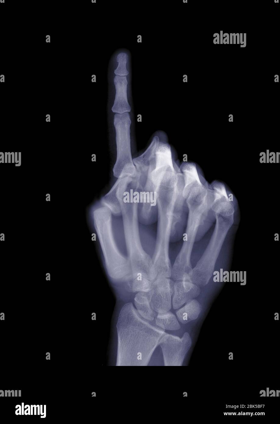 Hand hält einen Zeigefinger, Röntgenstrahlung. Stockfoto