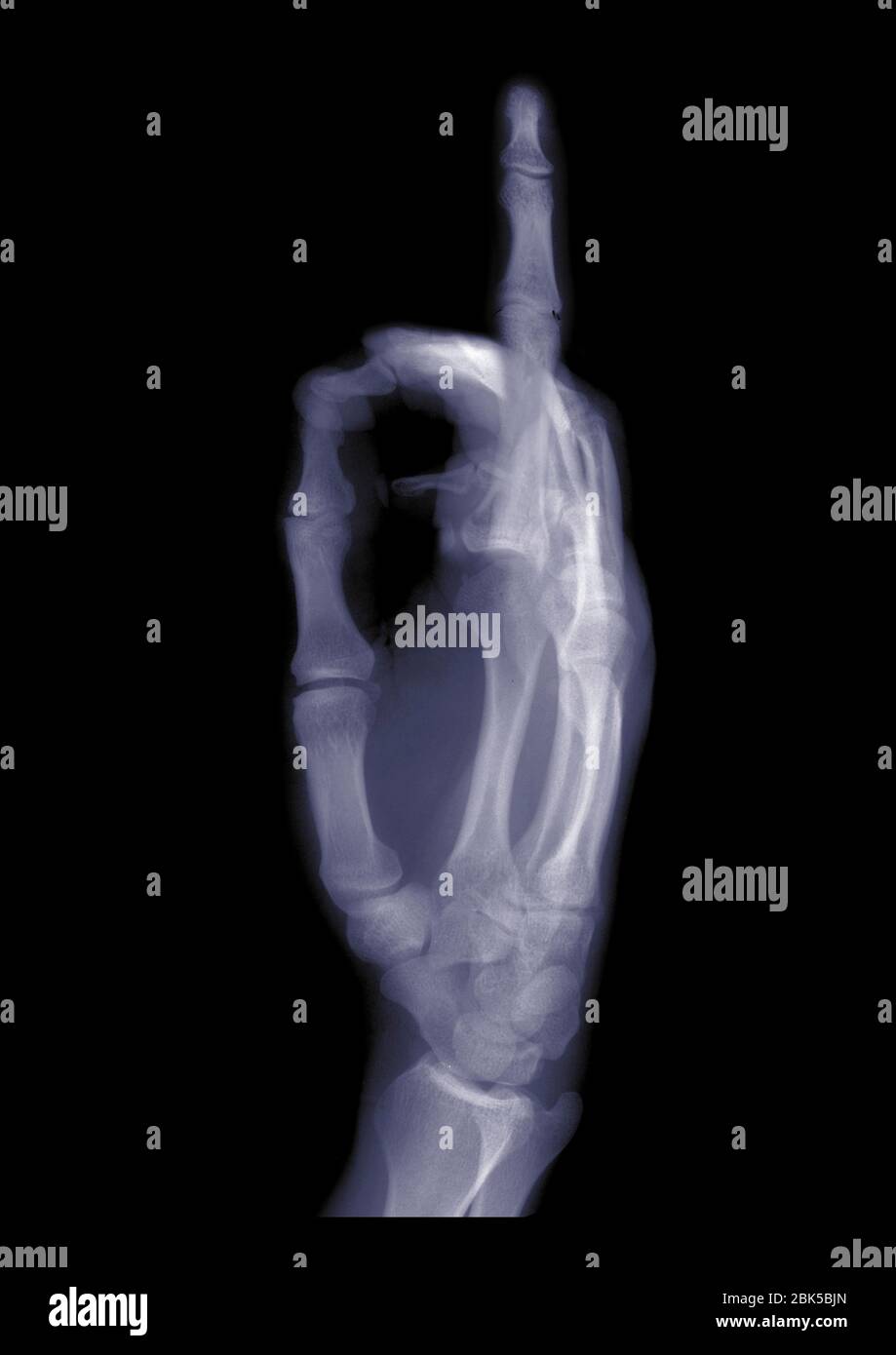 Hand hält einen Zeigefinger, Röntgenstrahlung. Stockfoto