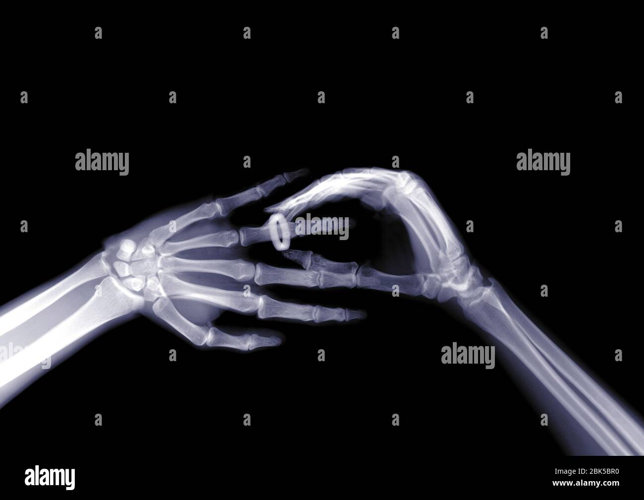 Ehering wird auf den Finger einer Person gelegt, Röntgenstrahlen. Stockfoto