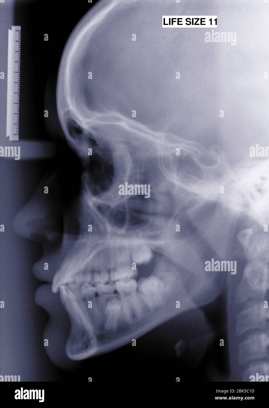 Schädel und Gesicht, Röntgenstrahlung. Stockfoto