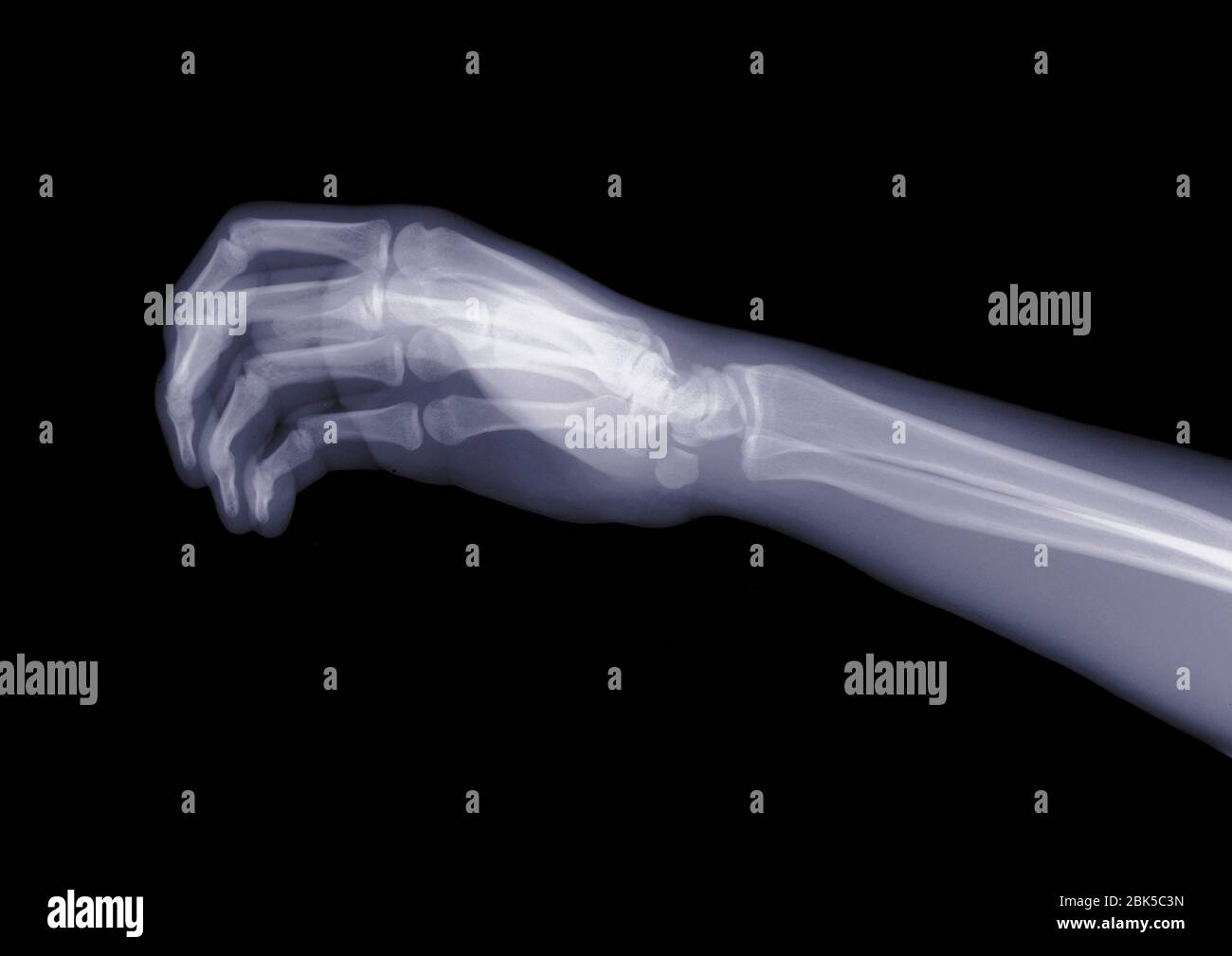 Hand und Arm von der Seite, Röntgen. Stockfoto