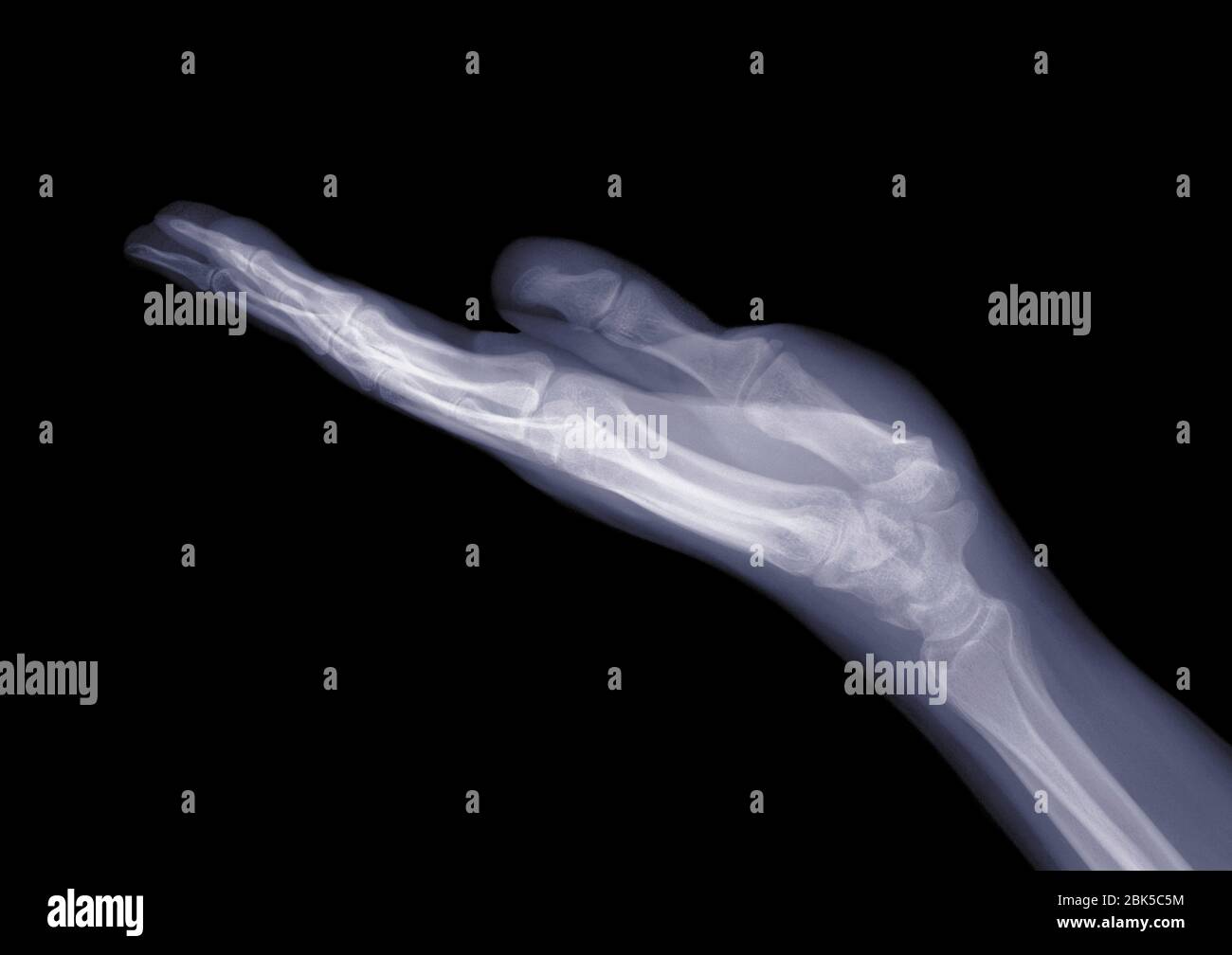 Hand mit offener Handfläche, Röntgen. Stockfoto