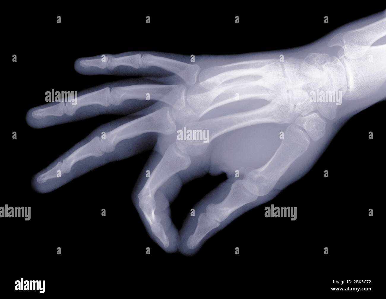 Hand, Röntgen. Stockfoto
