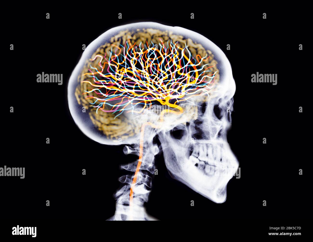 Schädel mit Gehirn und Neuronen, farbiger Röntgenstrahl. Stockfoto