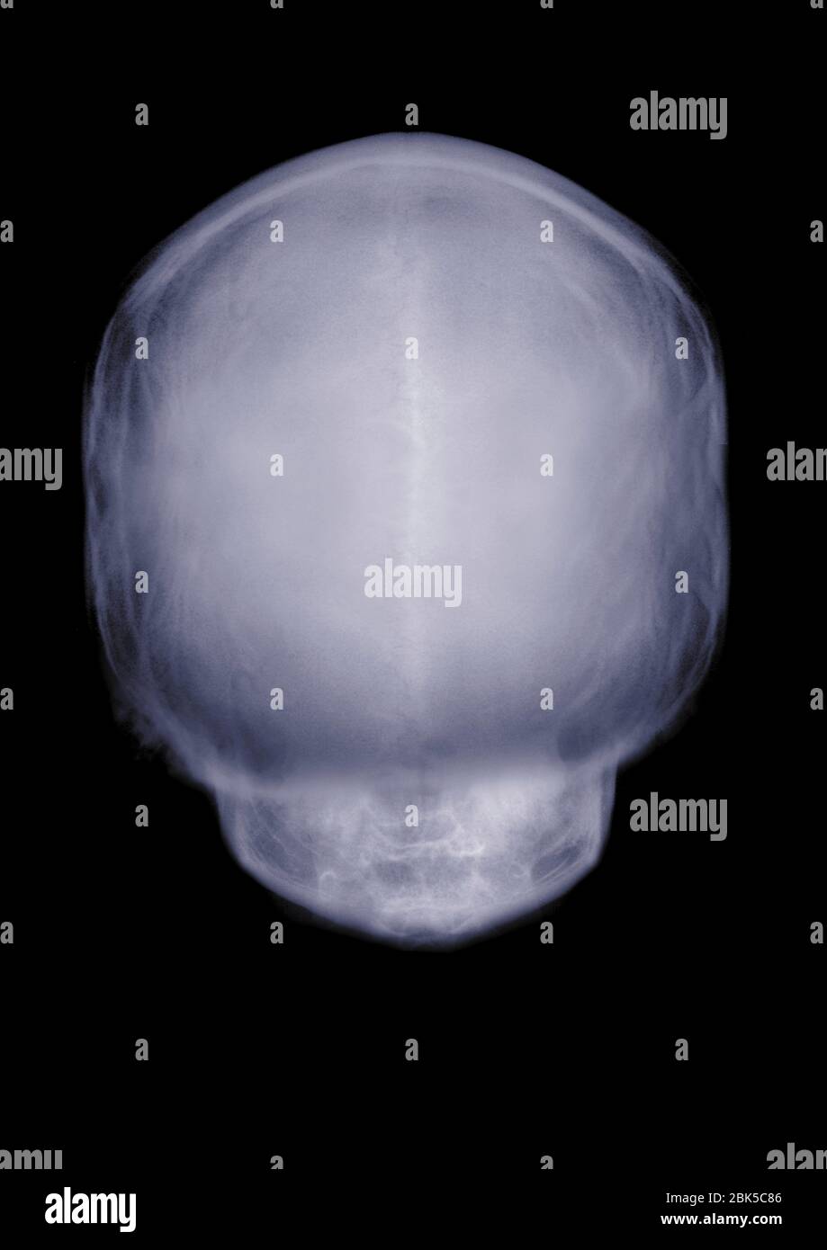 Menschlicher Schädel Rückansicht, Röntgen. Stockfoto