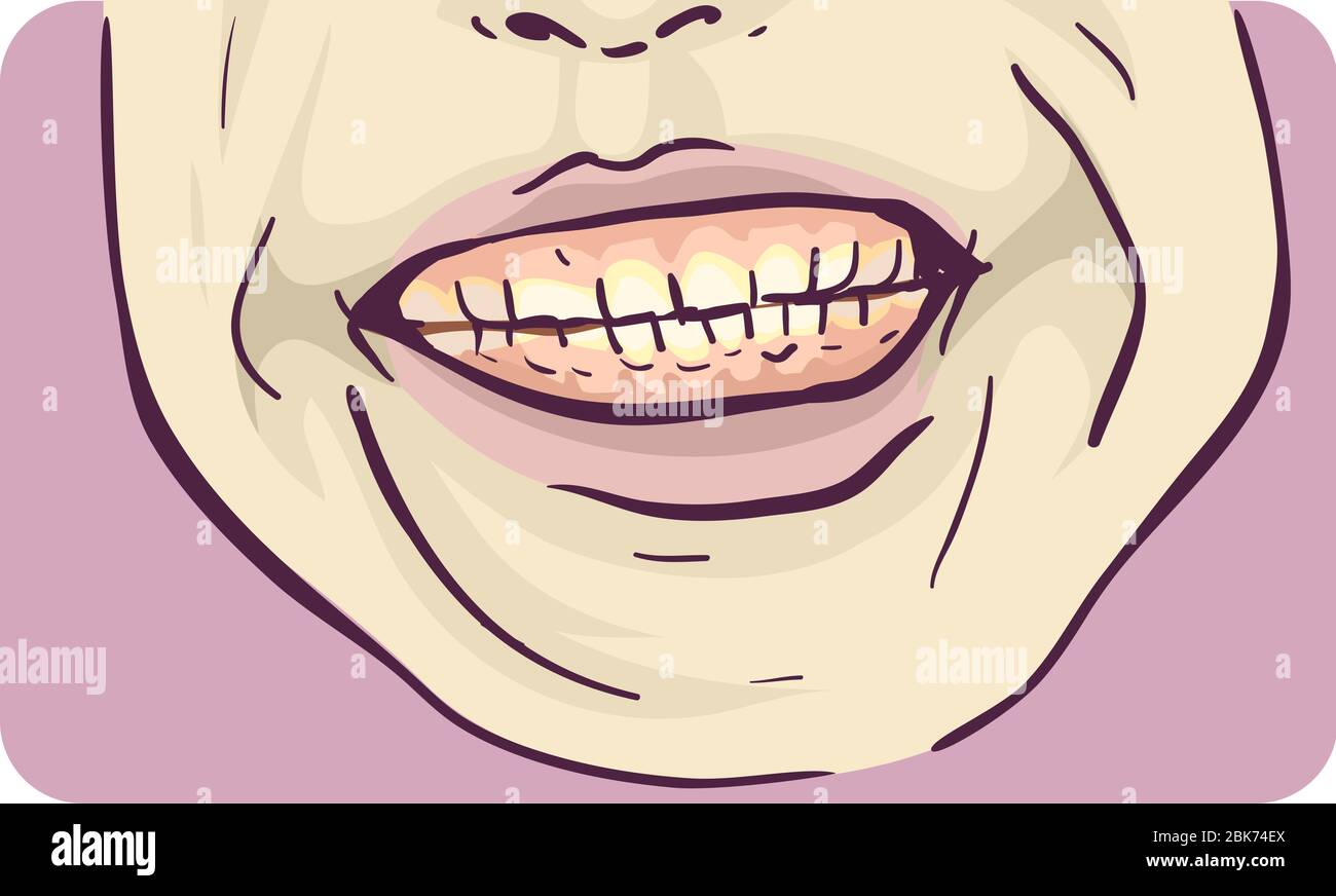 Illustration der Zähne Grinding Symptom der Bruxismus Stockfoto